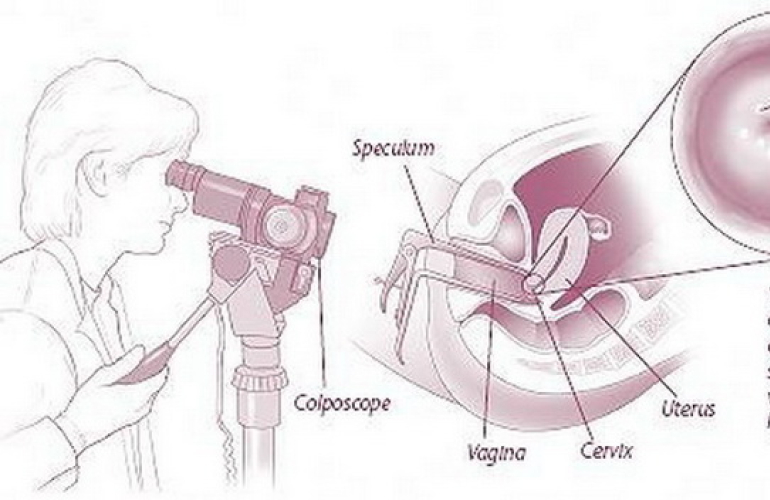 HPV και Κολποσκόπηση